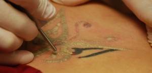 Tattoo-Removal-620x300