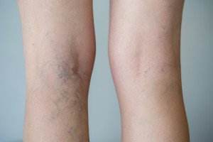 Spider Vein Treatment in Miami