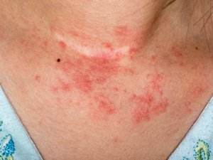 patient with Atopi Dermatitis