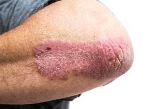 Patient with Psoriosis on their forearm