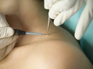 Patient getting a wart removed