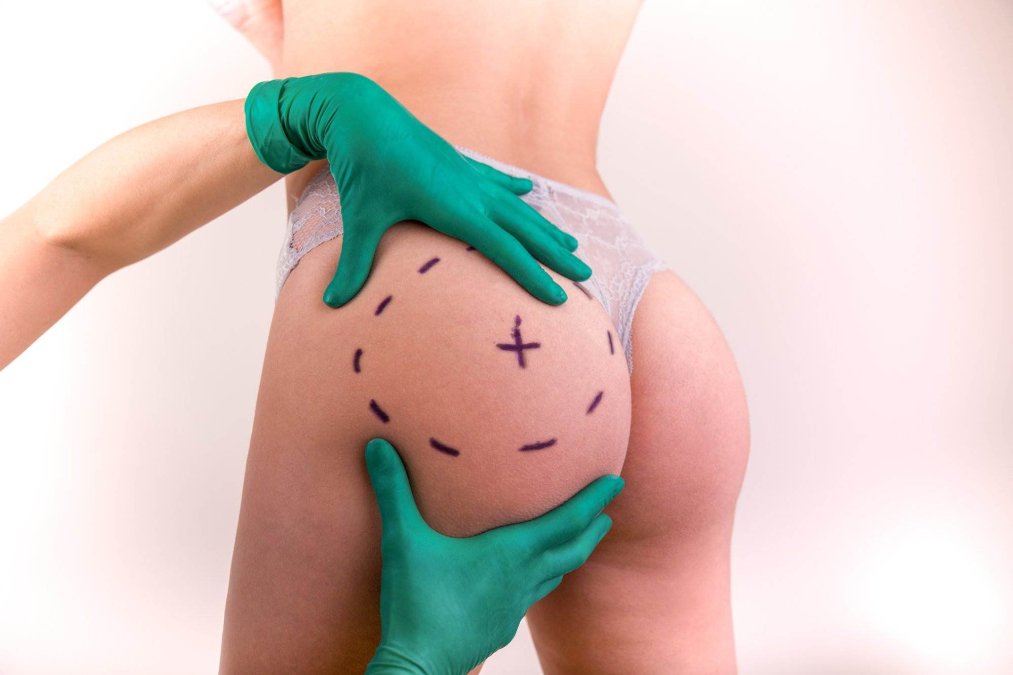 Miami Center for Cosmetic Dermatology – Dr. Deborah LongwillNon-Surgical  Butt Lift | Miami Center for Dermatology